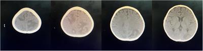 Juvenile dermatomyositis with central nervous system involvement: two case reports from a retrospective single-center cohort, with literature review